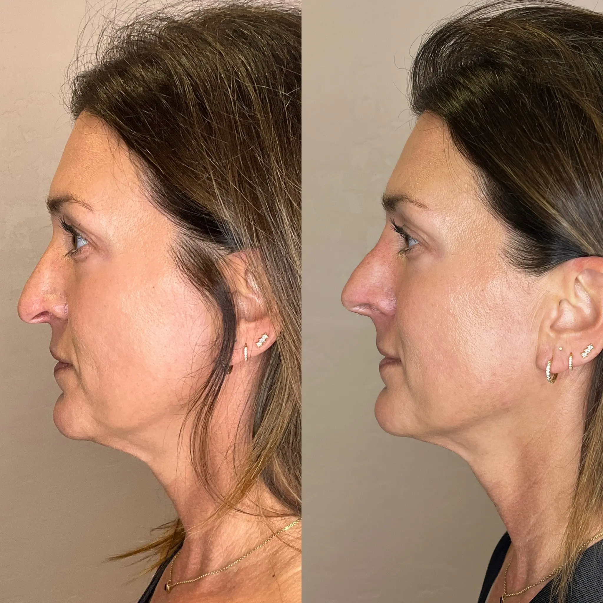 Non-surgical rhinoplasty result — tip support