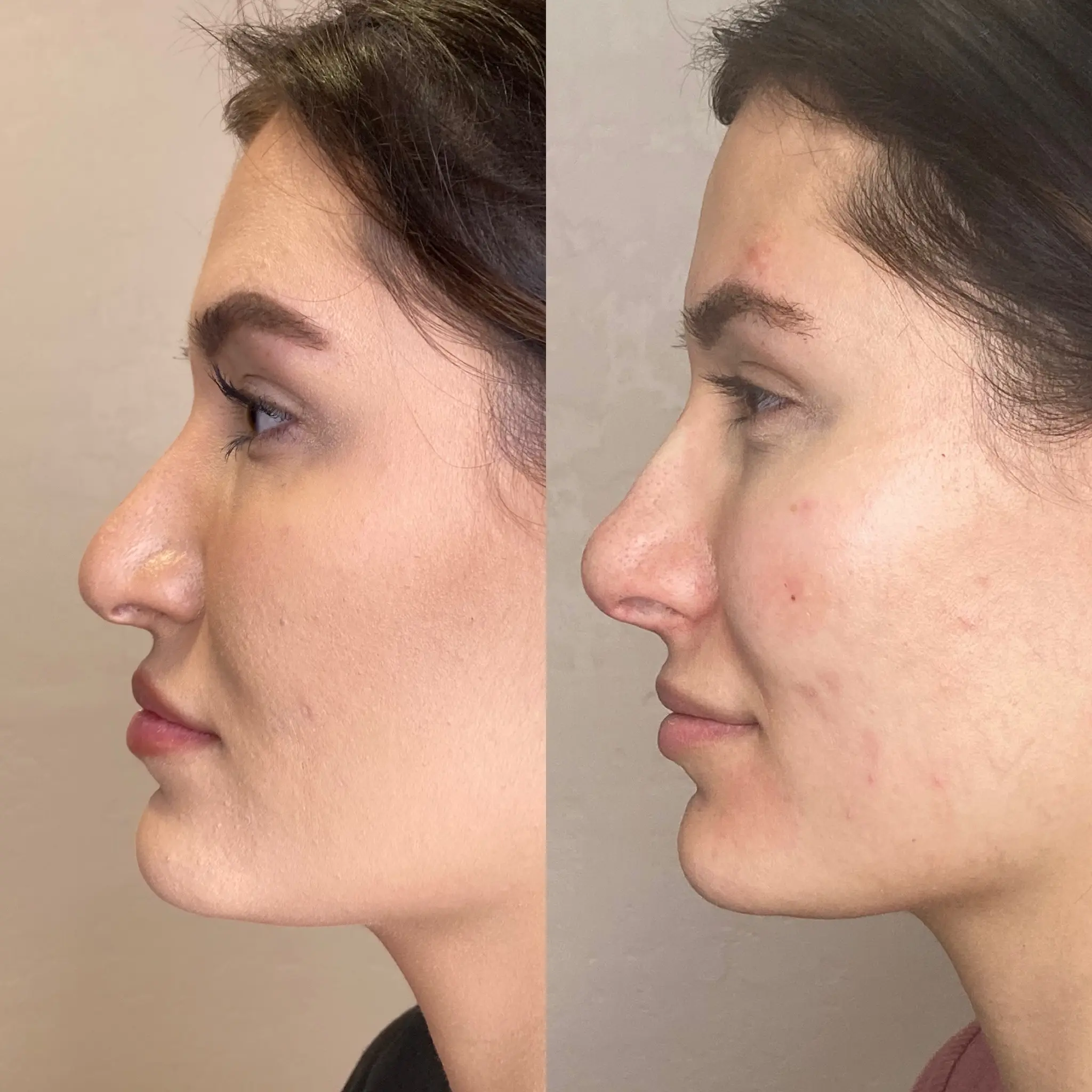 Non-surgical rhinoplasty result — profile balance