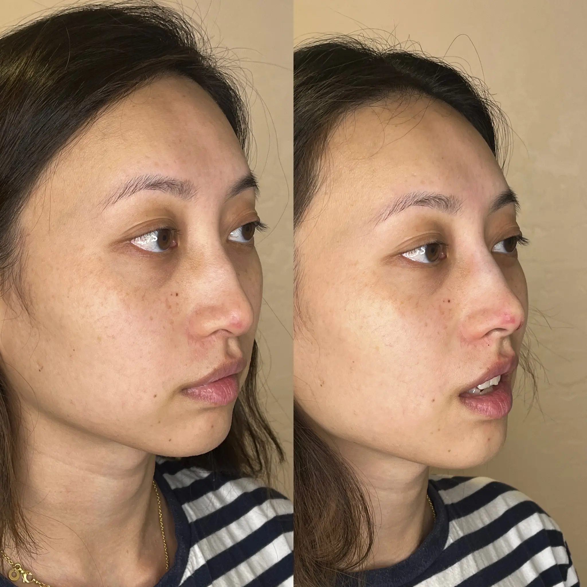 Non-surgical rhinoplasty result — bridge refinement