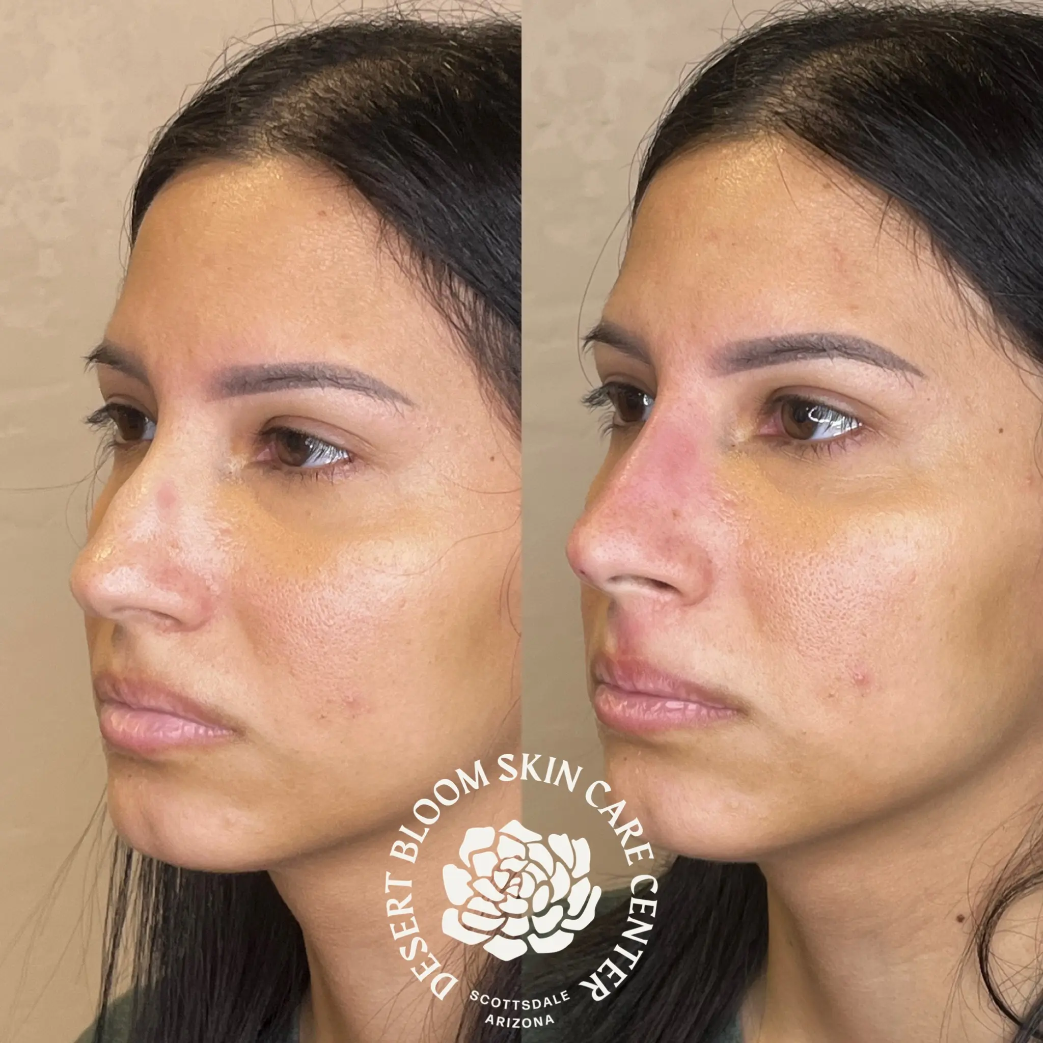 Non-surgical rhinoplasty before and after — Desert Bloom patient
